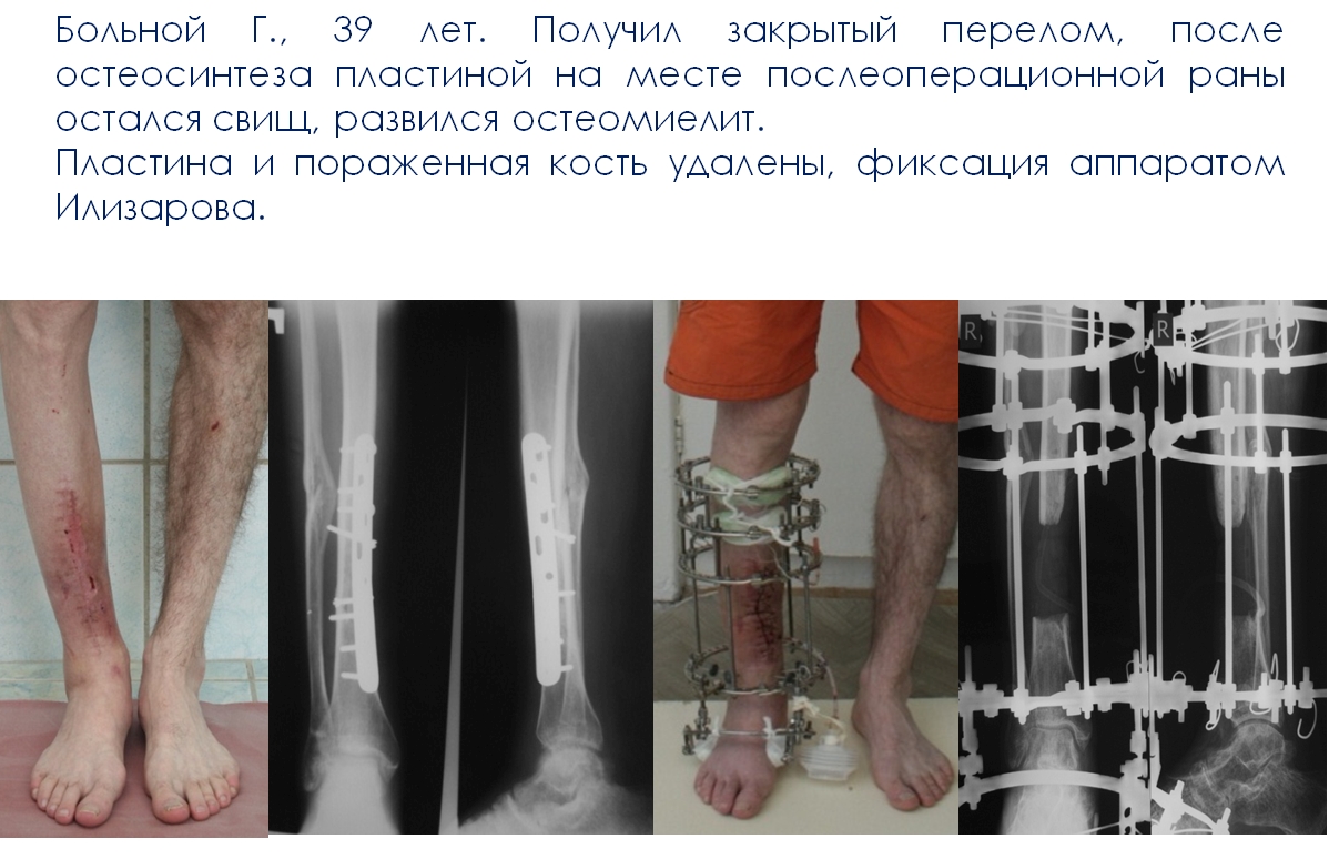 Остеомиелит пальцев стопы. 3 перелом 3 плюсневой кости стопы: Перелом плюсневой кости стопы. Симптомы остеомиелита: виды, формы и классификация Остеомиелит: причины, симптомы, диагностика и лечение