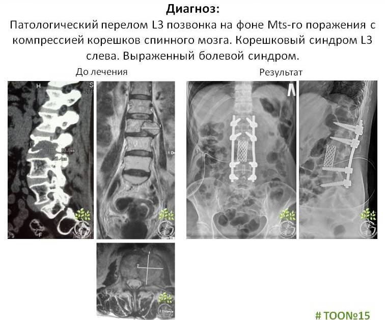 Удаление грыжи в центре илизарова